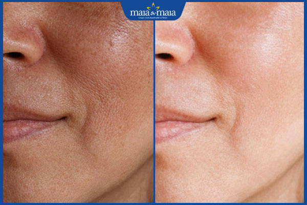 Trẻ hóa da bằng IPL có hiệu quả không? Chi phí bao nhiêu? 5 kết quả ipl