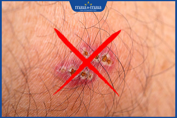 không dùng khi da nhiễm trùng