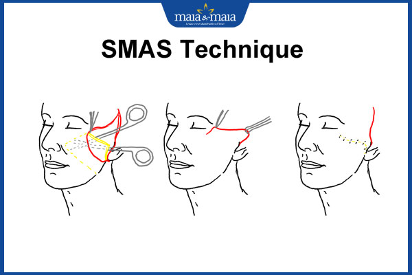 Căng da mặt SMAS: Giải pháp cho làn da rạng rỡ không tuổi 3 kỹ thuật căng da smas
