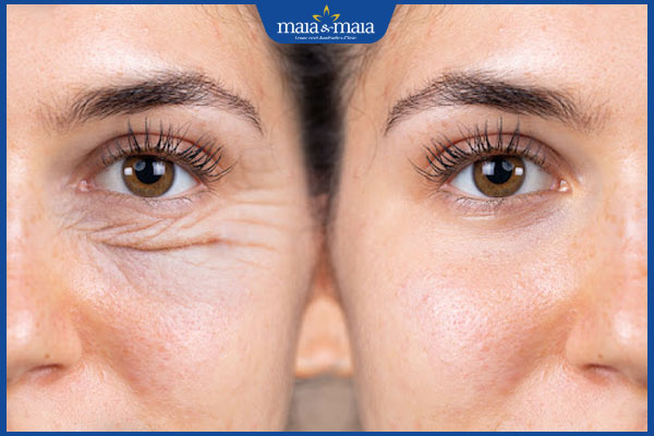 Trẻ hóa da bằng Laser Toning có tốt không? Quy trình và chi phí thực hiện 3 lợi ích trẻ hóa da