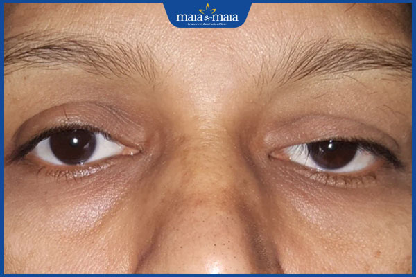 Nâng cơ mí mắt: Giải pháp trẻ hoá "cửa sổ tâm hồn" ưu việt 3 mí mắt bị sụp