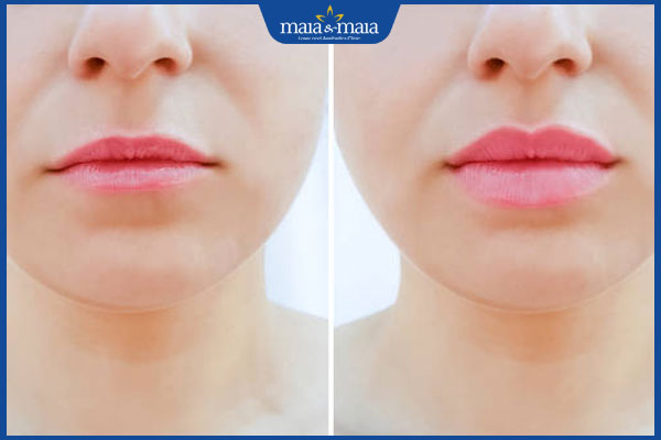 môi mỏng và môi dày