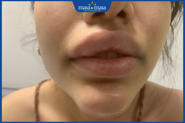 Tiêm filler môi bị sưng: Nguyên nhân và cách khắc phục hiệu quả 2 môi sưng sau tiêm filler