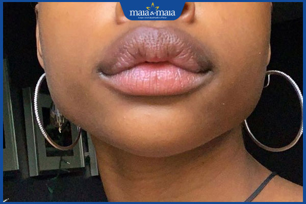 người có môi quá dày