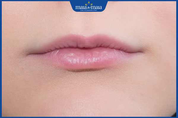 Tiêm môi tây căng mọng, quyến rũ: Xu hướng thẩm mỹ được giới trẻ ưa chuộng 3 người môi mỏng