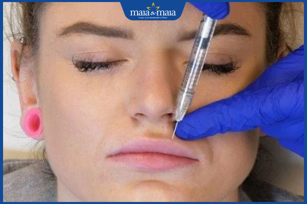 Ai nên thực hiện tiêm môi trái tim? Quy trình như thế nào? 3 người nên tiêm môi trái tim