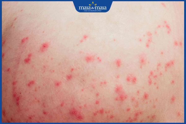 nổi mẩn đỏ ở mông