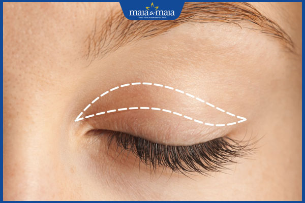 Nâng cơ mí mắt: Giải pháp trẻ hoá "cửa sổ tâm hồn" ưu việt 4 phẫu thuật mí mắt