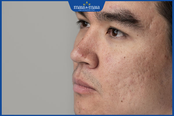 Gợi ý cách trẻ hóa da mặt cho nam hiệu quả, an toàn 2 sẹo mụn ở nam giới