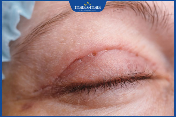 Nâng cơ mí mắt: Giải pháp trẻ hoá "cửa sổ tâm hồn" ưu việt 5 sẹo sau nâng cơ mí mắt