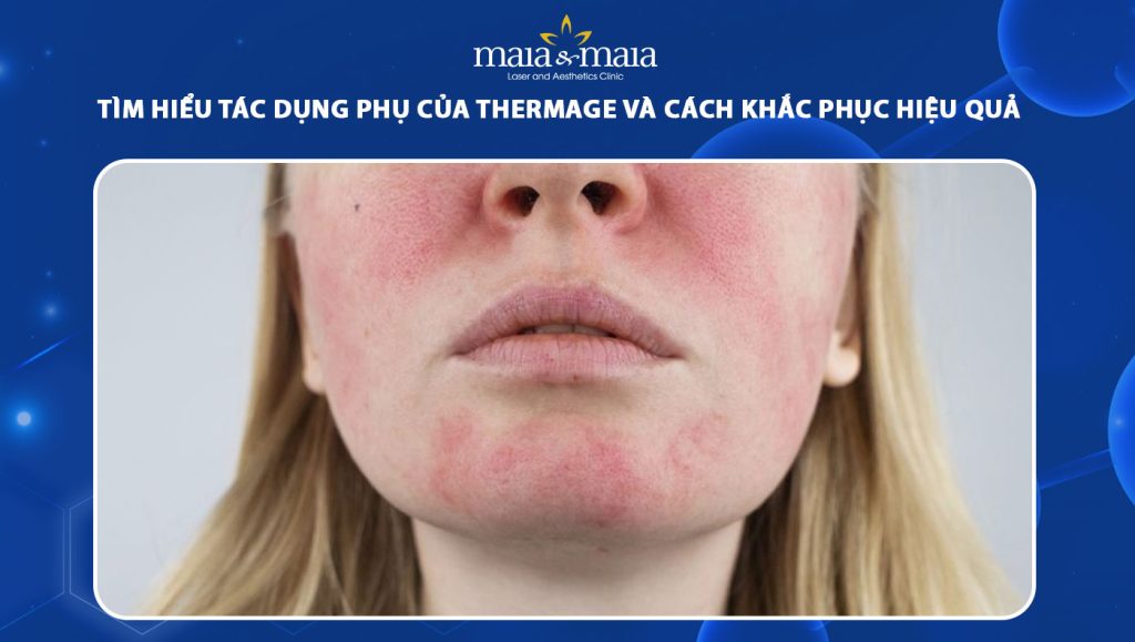 tác dụng phụ của thermage