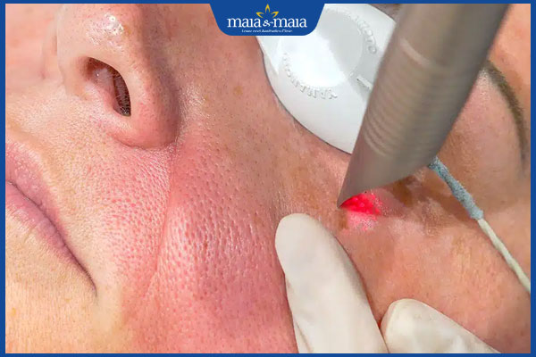 Phương pháp trẻ hóa da bằng công nghệ Fotona 4D không xâm lấn 2 thực hiện công nghệ fotona