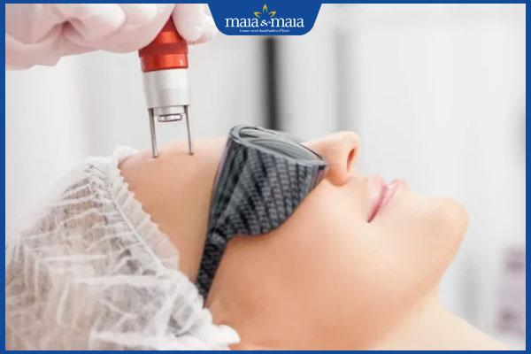 Trẻ hóa da bằng Laser Picosure có tốt không? Quy trình và chi phí thực hiện 2 thực hiện trẻ hóa da bằng laser picosure