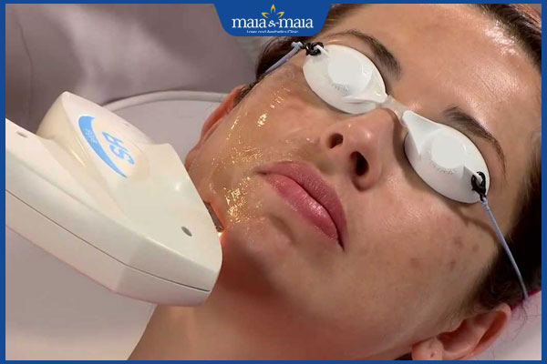 Trẻ hóa da bằng công nghệ Elight: Quy trình và lưu ý khi thực hiện 4 thực hiện trẻ hóa da với công nghệ elight
