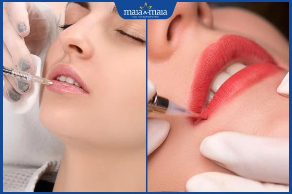 Nên phun hay tiêm filler môi trước? Bí quyết sở hữu dáng môi đẹp 2 tiêm filler và phun môi