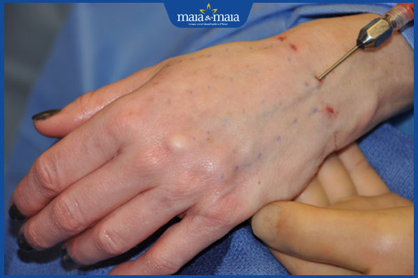 Trẻ hóa bàn tay cách nào hiệu quả? Địa chỉ trẻ hóa da tay uy tín 4 tiêm mỡ trẻ hóa bàn tay