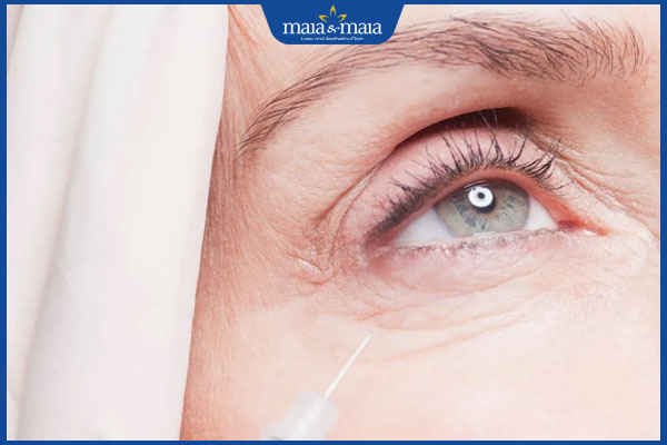 Tiêm xóa nhăn mắt có hiệu quả không? Chăm sóc da như thế nào? 3 tiêm xóa nhăn vùng mắt lão hóa