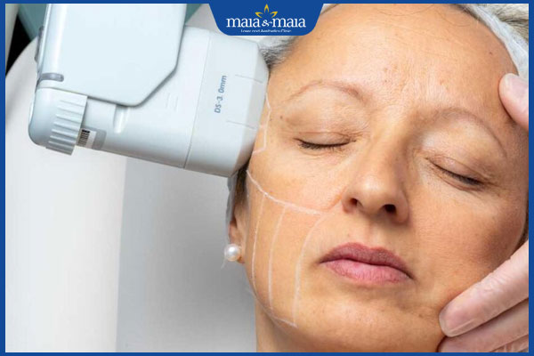 trẻ hóa da bằng công nghê hifu