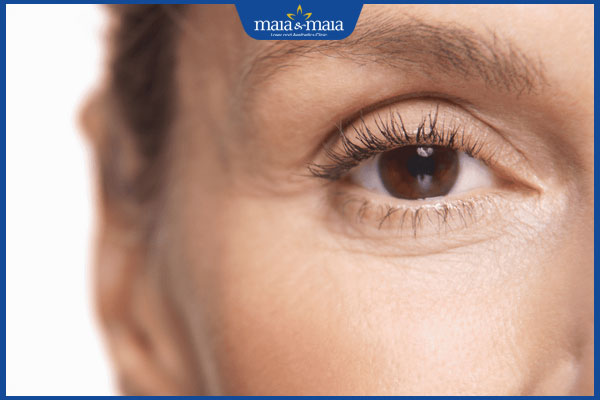 vùng mắt bị lão hóa