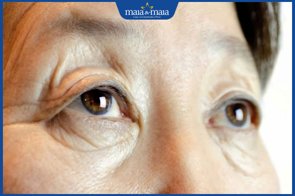 vùng mắt lão hóa