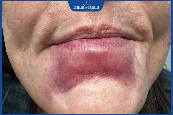 Tiêm filler cằm bị đỏ: Nguyên nhân, cách xử lý và hạn chế biến chứng 2 bị đỏ sau tiêm filler cằm