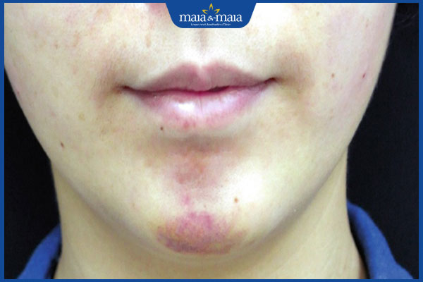 Có nên tiêm filler cằm không? Lợi ích và rủi ro tiềm ẩn khi thực hiện phương pháp này 6 biến chứng filler cằm