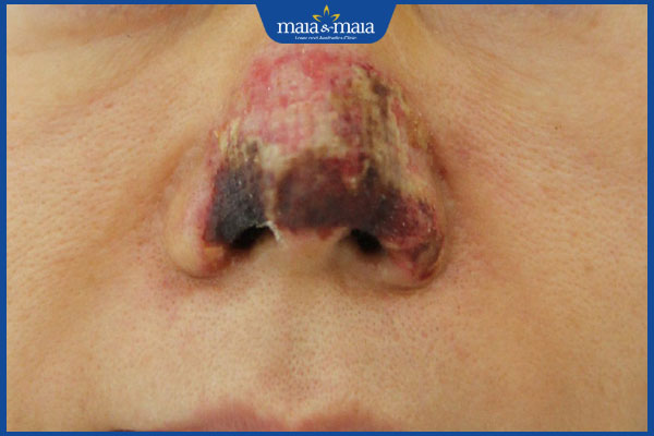 Tiêm filler mặt lệch: Giải pháp cho gương mặt cân đối không phẫu thuật 4 biến chứng nghiêm trọng sau tiêm filler mũi