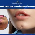 Biến chứng tiêm filler cằm