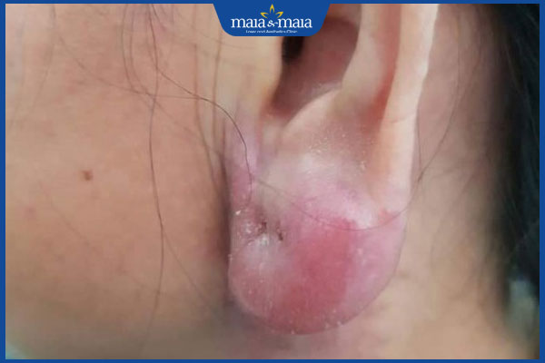 Tiêm filler tai phật: Rủi ro thường gặp và lưu ý cần ghi nhớ 3 biến chứng tiêm filler tai