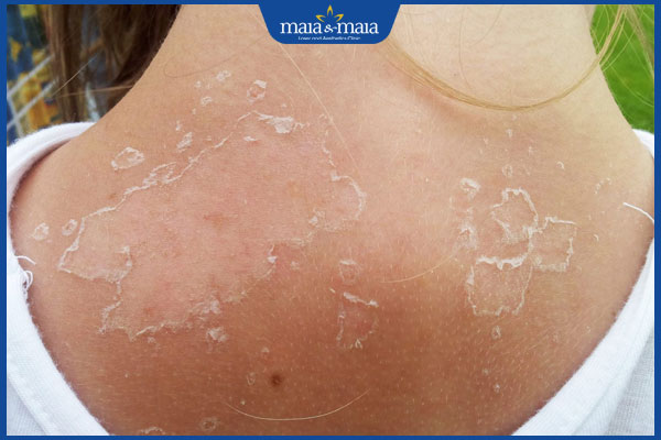 Peel da body có tốt không? Quy trình và cách chăm sóc sau peel da 4 bong da body sau peel