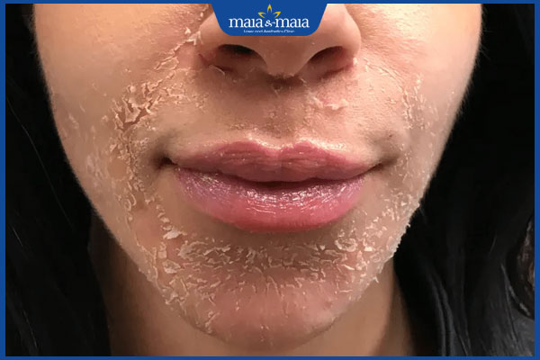 Làm sao để peel da nhanh bong? Tổng hợp 6 điều cần chú ý sau peel 2 bong da sau peel