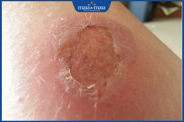 Điểm danh 7 tiêu chí giúp lựa chọn địa chỉ peel da uy tín, an toàn 5 bỏng nặng sau peel