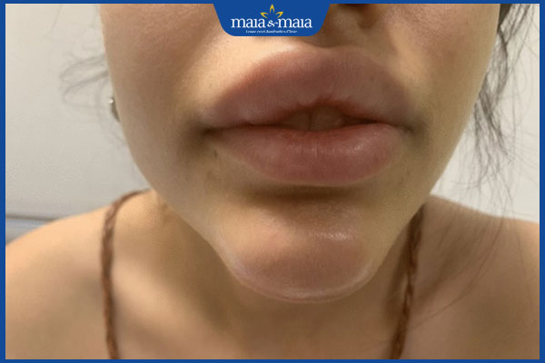 Tiêm filler cằm bị sưng do đâu? Biện pháp giảm sưng hiệu quả 2 cằm bị sưng