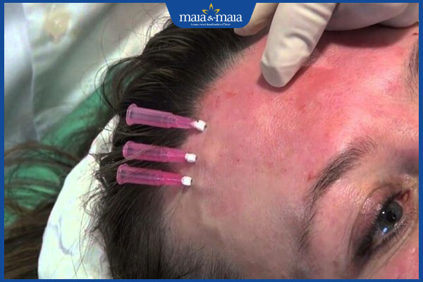 Nếp nhăn giữa 2 chân mày xóa bỏ được không? Cách cải thiện và phòng ngừa hiệu quả cao 5 căng chỉ vùng trán