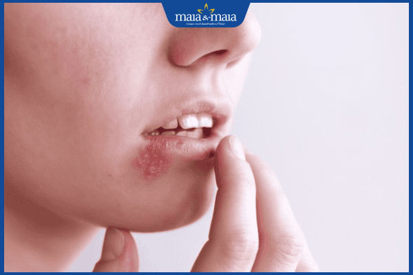 Tiêm filler môi bị nổi mụn nước có sao không? Cách xử lý kịp thời 2 cào gãi mụn nước ở môi