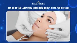 Cấy chỉ tơ tằm là gì? Ưu và nhược điểm khi cấy chỉ tơ tằm Chitossil 38 cấy chỉ tơ tằm