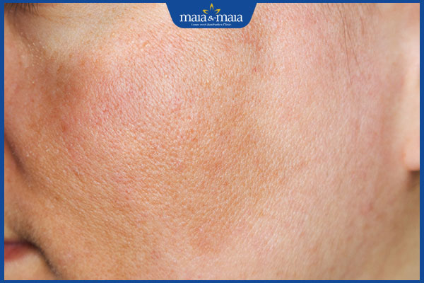 Cấy trắng da mặt có tốt không? Đối tượng nào nên thực hiện phương pháp thẩm mỹ này?  3 da bị loang lổ