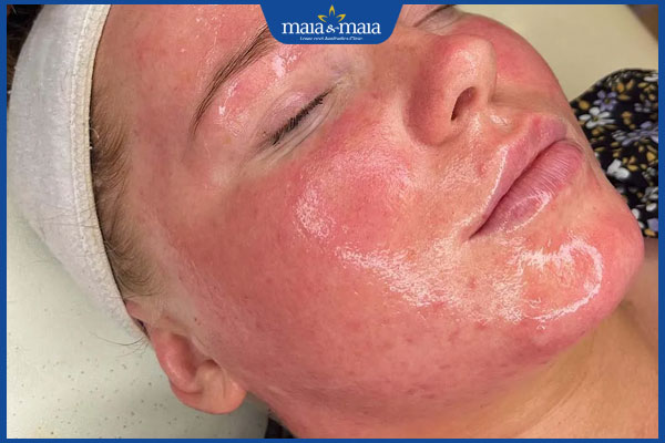 Peel da Retinol mang lại lợi ích gì? Những lưu ý nên biết 3 da kích ứng sau peel