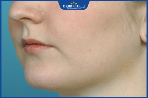 Tiêm cằm tròn: Đối tượng chỉ định và quy trình thực hiện  3 dáng cằm tròn