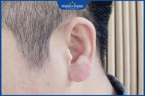 Có nên tiêm filler tai tài lộc không? Quy trình và chi phí thực hiện 2 dáng tai tài lộc