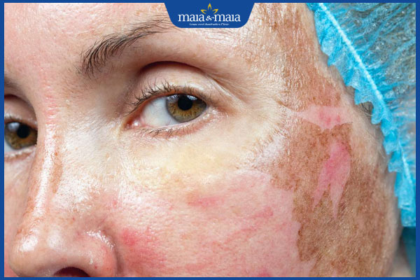 Peel da: Bí quyết sở hữu da căng bóng, mịn màng không tì vết 9 dấu hiệu đang peel da quá mức