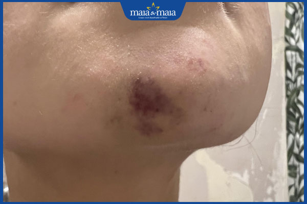 Vì sao tiêm filler cằm bị hoại tử? Dấu hiệu nhận biết là gì và cách xử lý hiệu quả  2 dấu hiệu filler cằm hoại tử