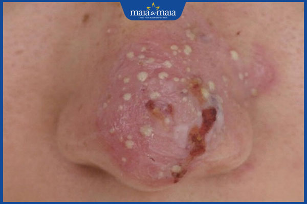 Điểm qua những dấu hiệu tiêm filler mũi bị hoại tử thường gặp 2 dấu hiệu hoại tử ở mũi