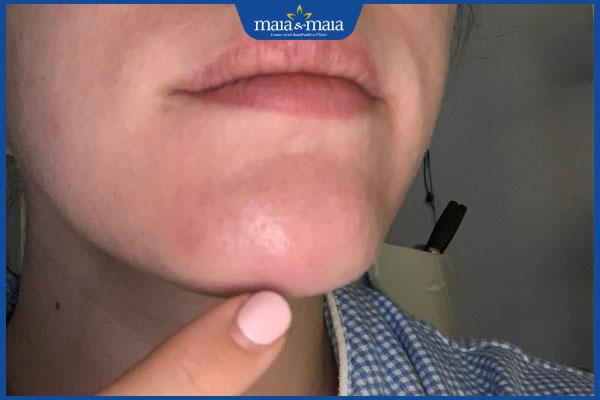 Tổng hợp biến chứng tiêm filler cằm: Chớ chủ quan khi làm đẹp 3 filler cằm vón cục