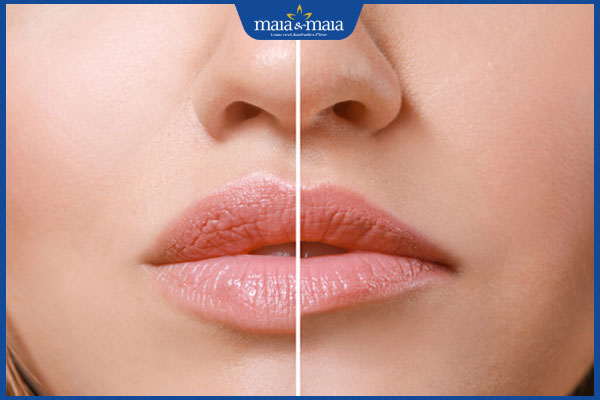 Tiêm filler môi bao lâu thì tan? Bí quyết duy trì hiệu quả tiêm lâu dài 2 filler môi tan
