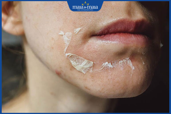 Thế nào là vi kim tảo biển? Hiệu quả làm đẹp có tốt như lời đồn? 6 hiện tượng thay da sinh học