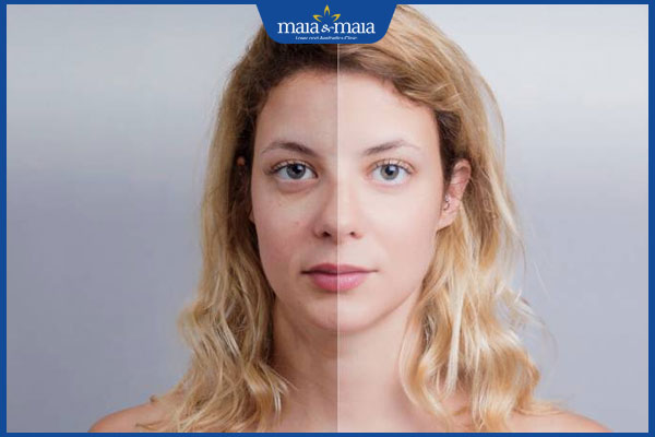 hiệu quả cấy trắng