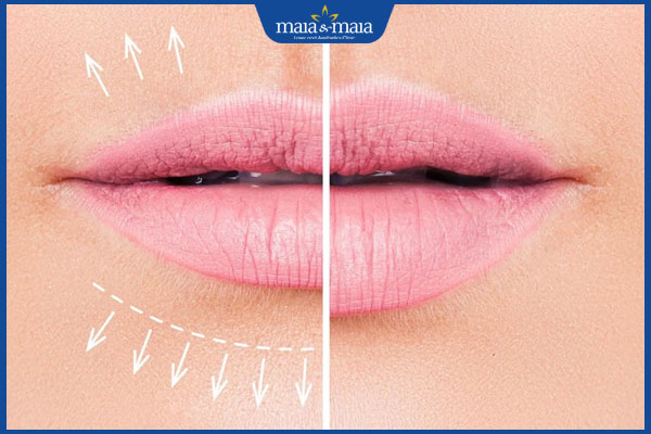 hiệu quả tiêm filler môi