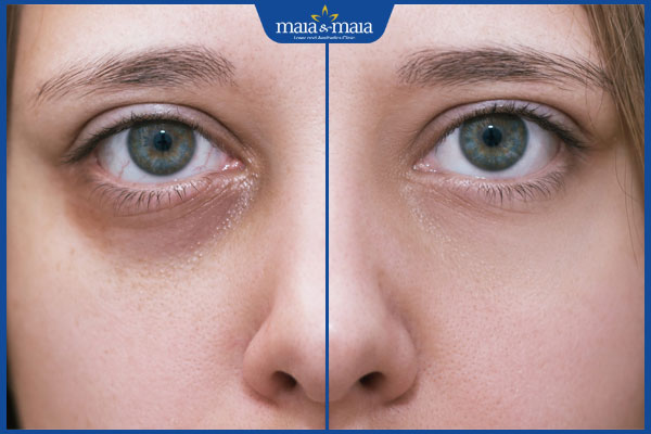 hiệu quả tiêm hốc mắt