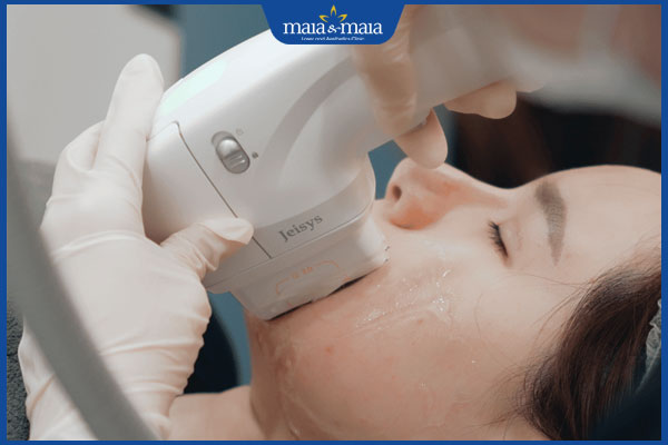 Phương pháp nào xóa nếp nhăn rãnh cười hiệu quả nhất hiện nay?  4 hifu rãnh cười